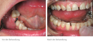 Zahnarzt Implantate Basel