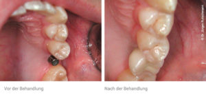 Zahnimplantate vorher nachher